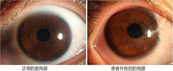 眼外伤致视力极差 郑州童瞳眼科使用RGP点亮患者“视”界